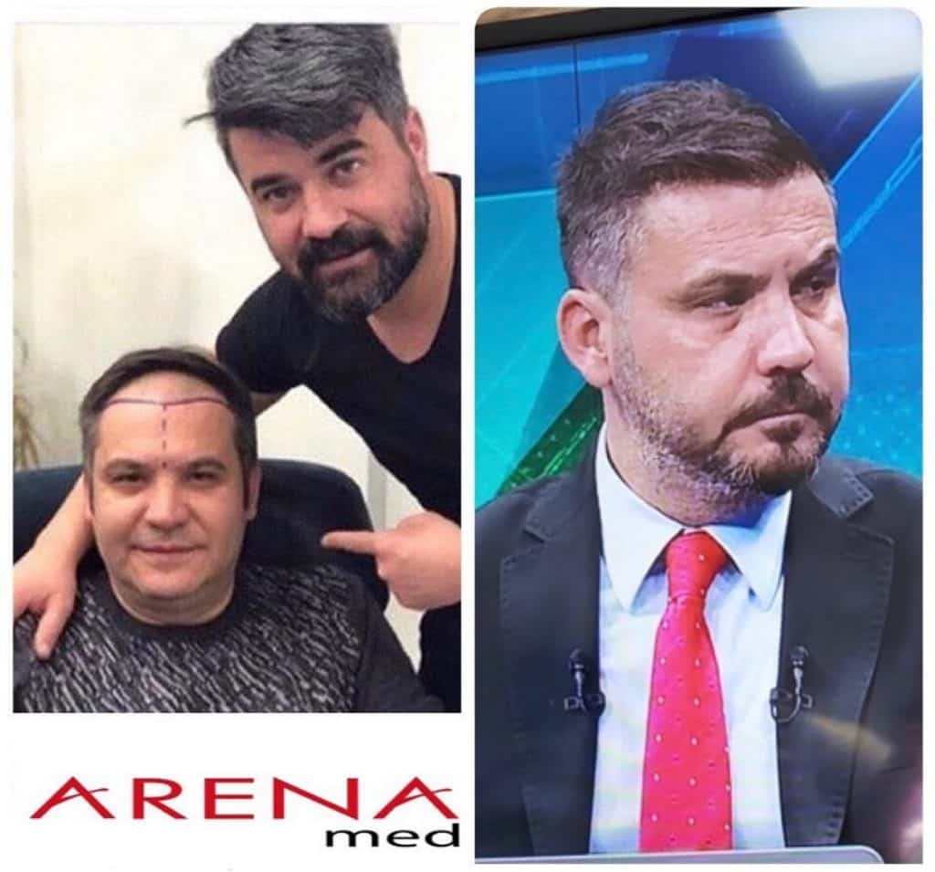 Arena Med Hair Transplant Results Before After Pictures