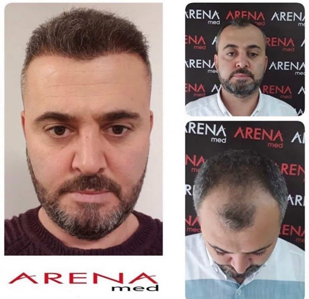 Arena Med Hair Transplant Results Before After Pictures