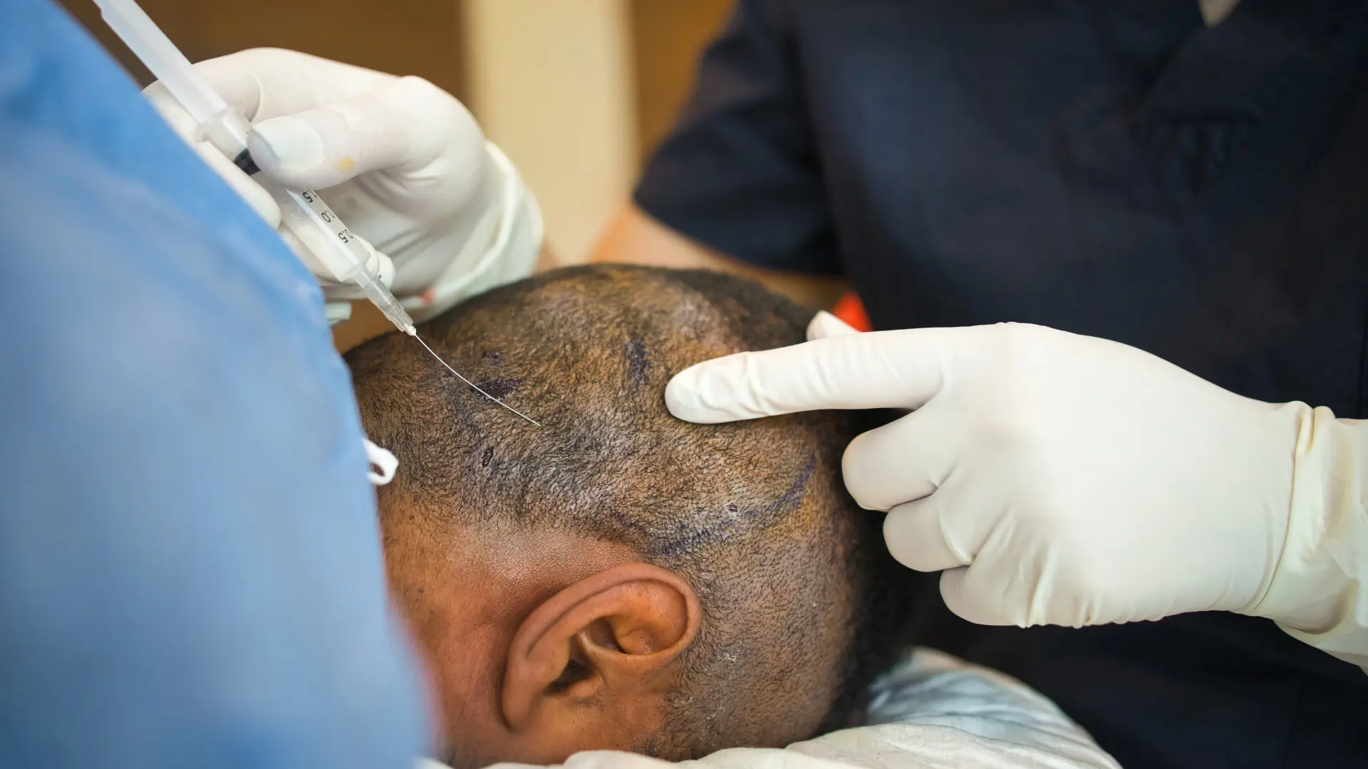 Repairing & Correcting Poor Hair Transplant Results